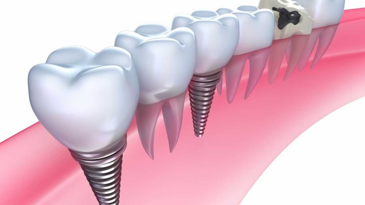 Candidate For Dental Implants - Metallic Implants Or Denture - 1366x768