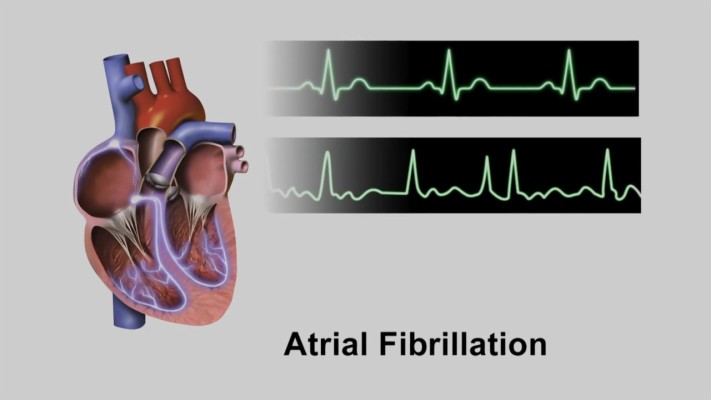 The Top Graph Shows A Normal Cardiac Rhythm - Fib Sleep Apnea ...