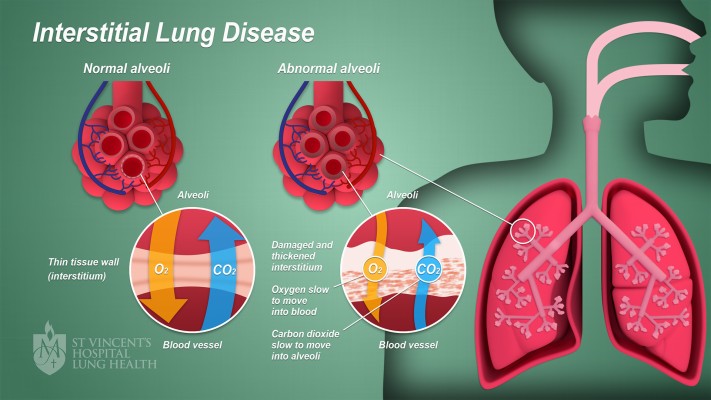 2 Svh Lung Health Interstitial Lung Disease Final - Graphic Design ...